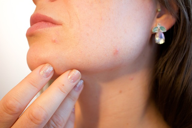 How to Get Rid of Pimples: What is the Best and Healthiest Way?
